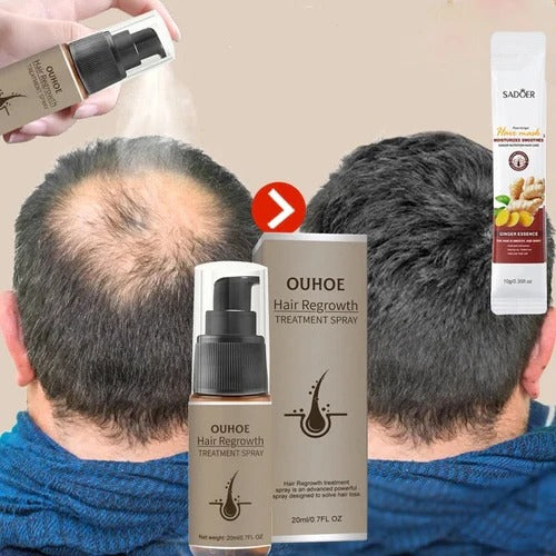 Spray de sérum de croissance des cheveux pour hommes et femmes, anti-chute de cheveux