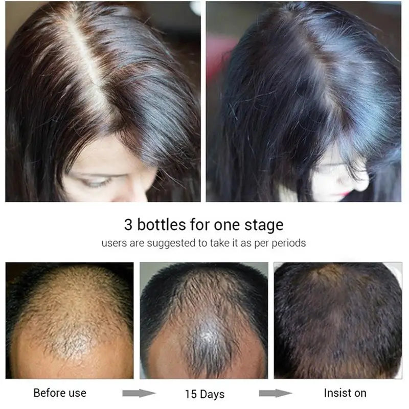 Spray de sérum de croissance des cheveux pour hommes et femmes, anti-chute de cheveux