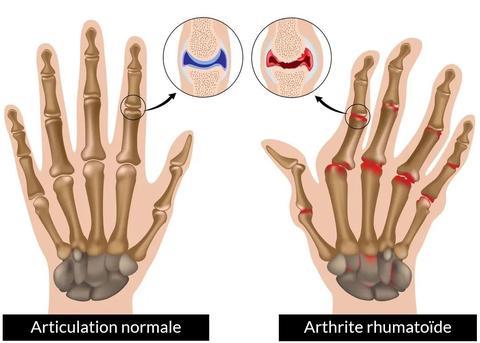 Mitaines de Compression Antidouleurs Arthrose